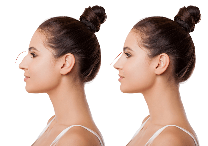 Sculpting Elegance: Navigating of Rhinoplasty in Turkey