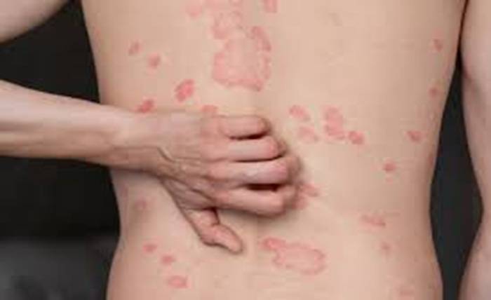 Why Psoriasis Is More Than Just a Skin Problem? Why Psoriasis Is More Than Just a Skin Problem?
